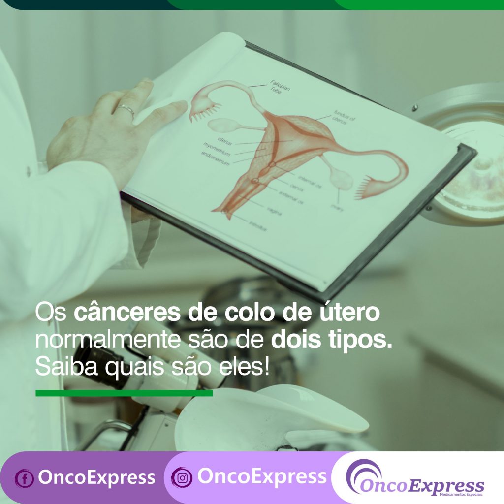 Os Cânceres De Colo De útero Normalmente São De Dois Tipos Saiba Quais São Eles Oncoexpress